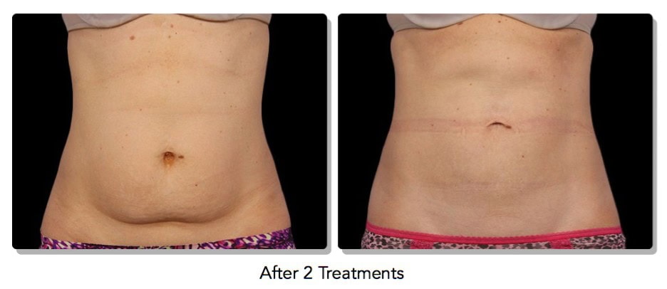 Coolsculpting